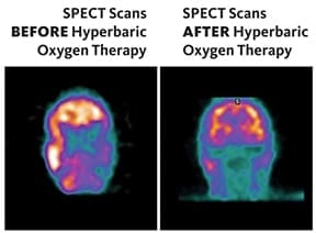 Improved brain function shown in SPECT scans after oxygen therapy.