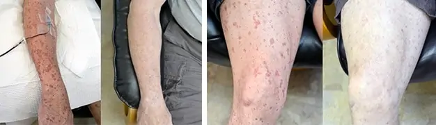 before after ozone treatment for dsap