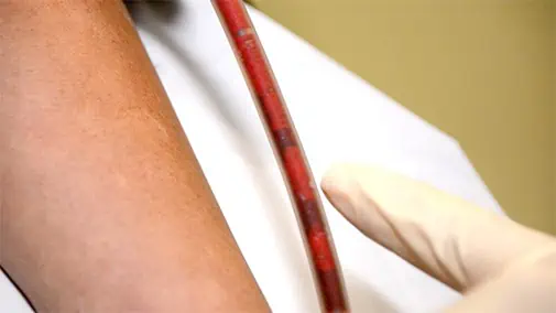 debris coming out of the blood of vacine injured patient