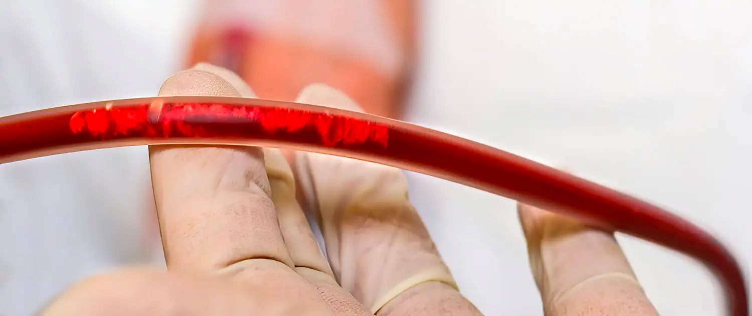 Gloved hand monitoring blood flowing through the tubing for EBOO (Ozone) therapy for Long COVID treatment.