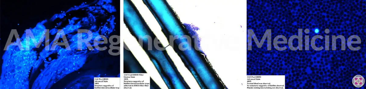 Patient 1143: Blood before and after EBOO/F treatment shown in photos.