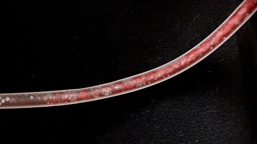 Ozone EBOO/F Treatment Clears Heavy Debris From Venous Blood