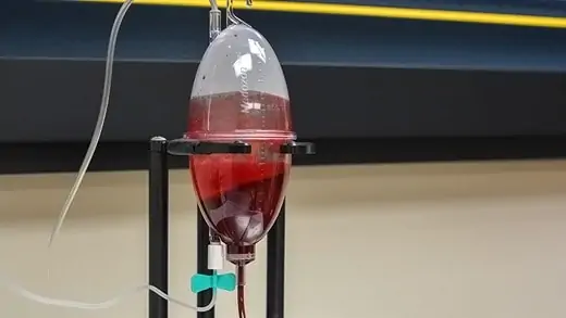 Container where the blood is ozonated.