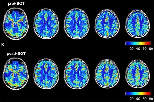 Before & After HBOT: Brain Perfusion MRI Changes Post-Covid