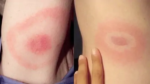 The “bullseye” rash that some people get with lyme disease