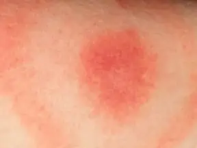The classic Lyme disease bullseye rash.