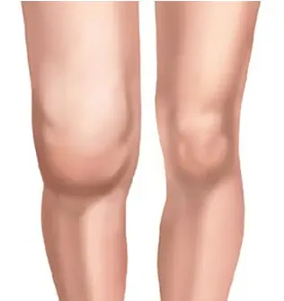 Lyme disease symptoms include severe joint pain and swelling