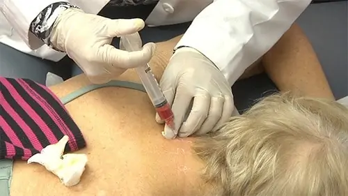 stem cell injection back