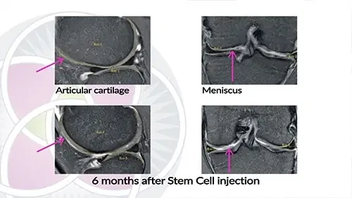 stem cell knee mri