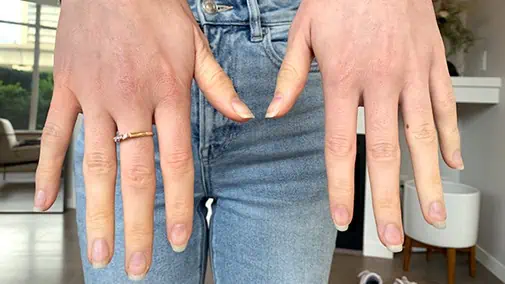 swolleen hand during long covid