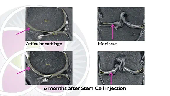 MRI showing knee cartilage regenerated using stem cells.