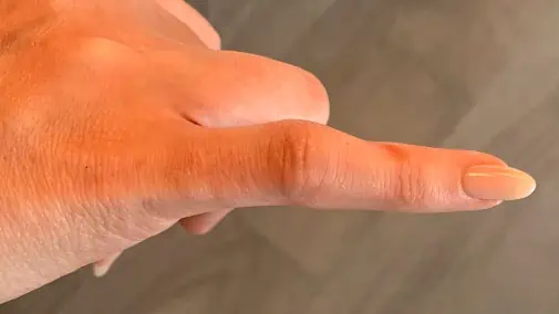 Ashley developed hand pain and swelling after mRNA vaccine.