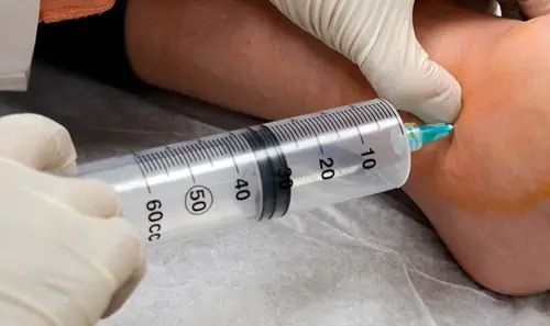 Dr. Pien injects ozone into the ankle to promote healing.