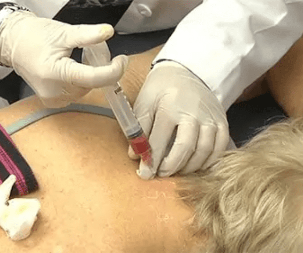 Dr. Pien's team administers a precise stem cell injection to target inflammation and repair damaged tissue, promoting natural healing from within