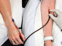Close-up of a patient’s arm with two IV lines inserted for the EBOO (Extracorporeal Blood Oxygenation and Ozonation) procedure.