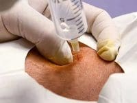 Close-up view of a prolozone injection procedure administering ozone gas directly into the patient's elbow joint.