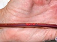 A close-up of the EBOO blood tubing showing visible debris and micro-clots removed during the cleansing process.