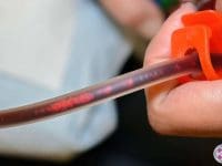Close-up of the apheresis tubing, revealing visible clumps of toxic metabolic debris being removed from the patient's bloodstream.