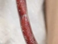 Close-up of white particles and debris visible in the blood tubing during EBOO treatment for Post-Vaccine Syndrome.