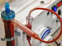 dialyzer-on-stratos-eboo-ozone-therapy-ama-regen-med