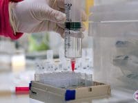 Detailed view of stem cell volume being precisely measured in a large syringe during the preparation phase of therapy.