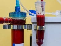 A tight close-up on the EBOO filter and the chamber where the blood is oxygenated and ozonated before returning to the patient.