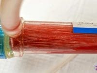 eboo-lots-of-debris-after-treatment-in-the-filter-extracorporeal-oxygenation-and-ozonation-ama-regenerative-medicine