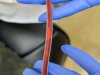 eboo-nurse-holding-tubing-containing-debris-removed-from-patients-blood-ama-regenerative-medicine