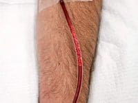 eboo-ozone-dialysis-blood-cleansing