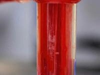 eboo-ozone-therapy-filter-from-long-covid-patient-ama