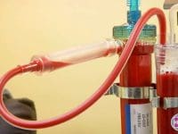 The dialyzer component of the EBOO ozone therapy device in use for blood purification.