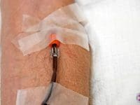 eboo-therapy-iv-blood-going-out