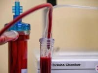 eboo-treatment-dialyzer-close-up-stratos-ozone-treatment-ama-regen-med