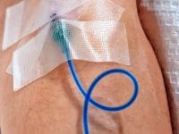 A close-up view of an intravenous line administering Methylene Blue directly into a patient's arm for Long COVID therapy.