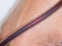 long-covid-patient-shows-debris-being-removed-from-blood-by-eboo-device-ama-regenerative-medicine-copy