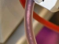 Visual evidence of micro-clots and debris being removed from the circulation of a patient undergoing EBOO for Long COVID.