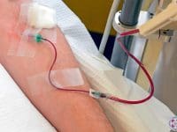 Detailed shot of the specialized IV setup and lines for the Multi-Pass Ozone Therapy treatment.