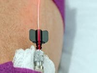 Close-up of intravenous red light therapy (photobiomodulation) being administered to the patient for Long COVID relief.
