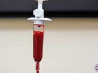 Close-up of the drip chamber during Single-Dose Ozone Therapy, showing the blood being ozonated.