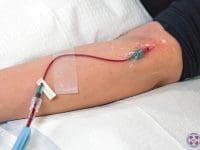 Close-up of the cannula insertion site in a patient's arm for Single-Dose Ozone Therapy (Major Autohemotherapy).