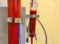 A close-up of the RENÅK Hollow Fiber Dialyzer, the key filter in the EBOO process for removing endotoxins and micro-clots.