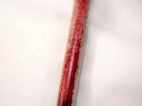 toxin-removed-from-blood-during-eboo-ozone-dialysis-treatment-ama