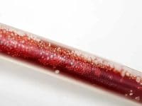 vaccine-injured-patients-blood-being-cleansed-by-eboo-treatment-ama